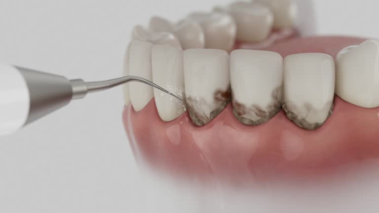 Trusted Wisdom Tooth Removal service in Reading, PA - Dentist Open Now